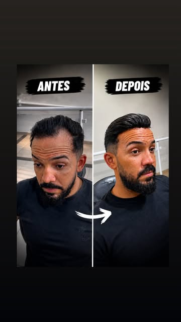 Resultado de prótese capilar